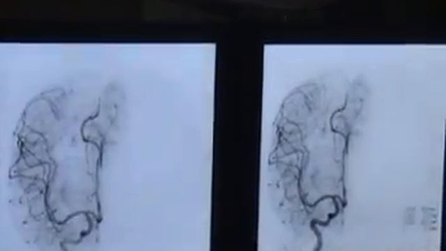Brain AVM Embolization with Onyx By Sibasankar Dalai смотреть онлайн