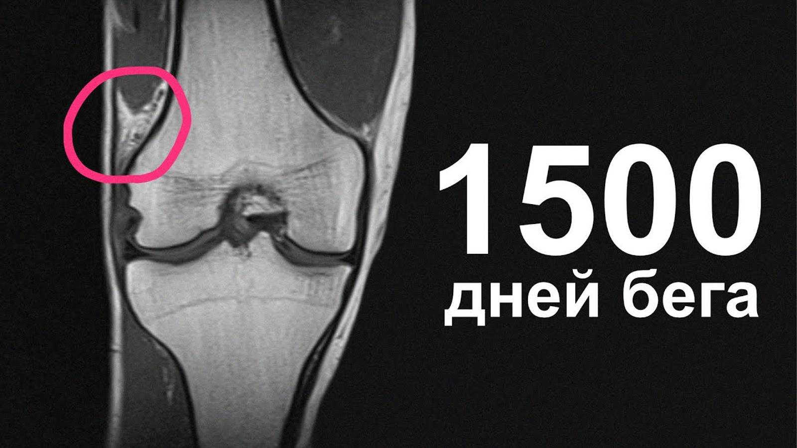 Что с коленом после 4 лет ежедневного бега? смотреть онлайн