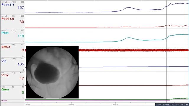 Video Regarding Video Urodynamic Study On A Patient By  Dr. Pawan.