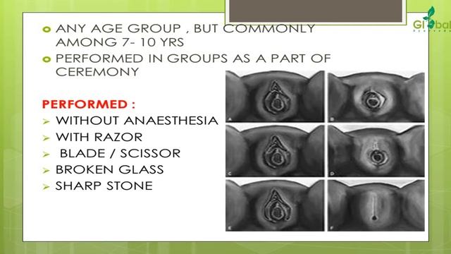 FEMALE GENITAL MUTILATION (CIRCUMCISION)