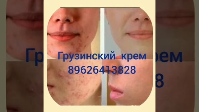 крем актив против загара веснушек и пигментации смотреть онлайн