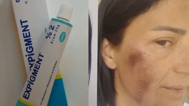اقوى مقشر لإزالة التصبغات و الحبوب /اكسبيجمنت/expigment/معلومات مهمة ممنوع الاهمال