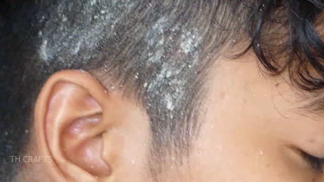 Dandruff Removal On Front Side Of Head!! Itchy Dry Scalp Dandruff Scratching #02