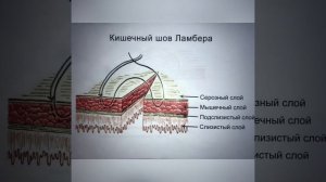 Однорядный серозно-мышечный шов Ламбера