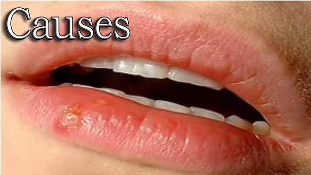 Herpes simplex virus: Causes ,Symptoms & permanent cure with no side effect смотреть онлайн
