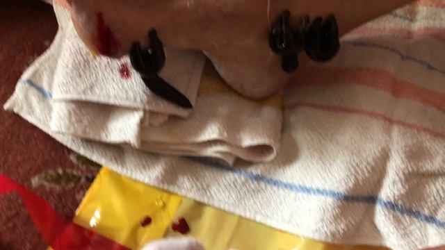 Хирудотерапия при Диабет. Хирудо Пиявици за разреждане на кръвта и запушени кръвоносни съдове. смотреть онлайн