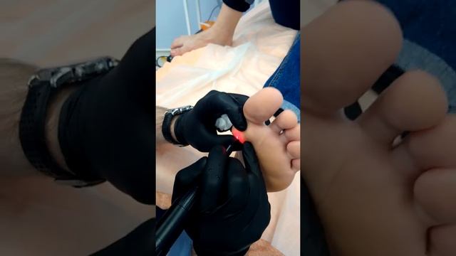 Удаление бородавки в клинике 