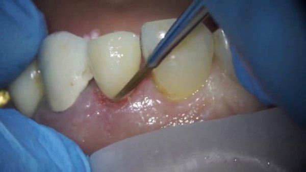 Покраска коронки в полости рта , подбираем цвет. Коронки emax #dental #dentist #dentistry #crowns