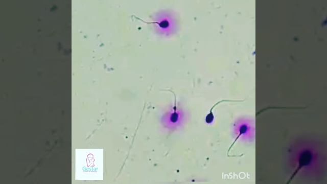 Fragmentación de ADN espermático - Test de la Dispersión de la Cromatina смотреть онлайн