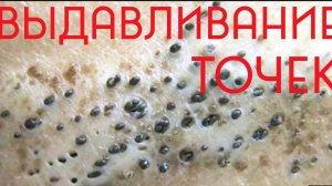 ✅ Выдавливание черных точек новое 2026  Чистка лица прыщи выдавливание_ Шугаринг дома