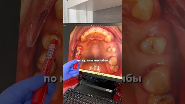 Отвечаю на вопрос из комментариев #имплантациязубов