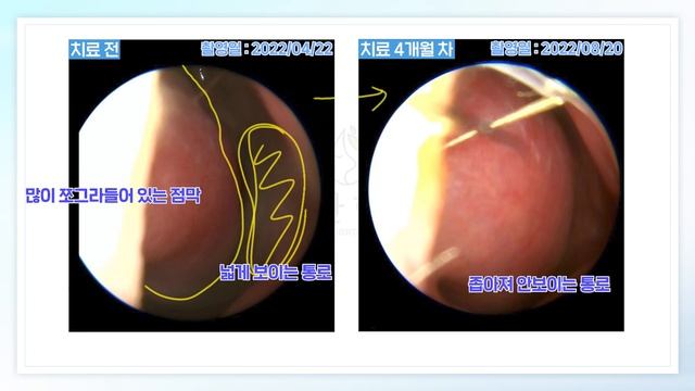 하루종일 콧물이 줄줄줄 나온다면?!🤧 (70대 환자 실제 사례)👃 смотреть онлайн