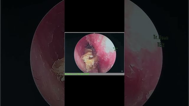 Satisfying Removal Of Impacted Earwax 2023-11-18 #relaxing #satisfying #asmr #earwax
