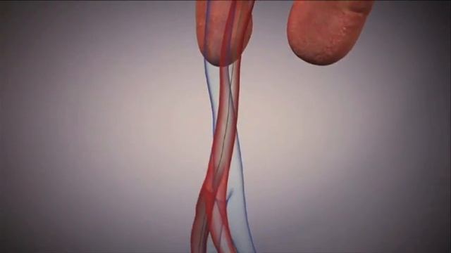 Transfermoral Deployment of Edwards SAPIEN Transcatheter Heart Valve in Calcified Aortic Valve смотреть онлайн