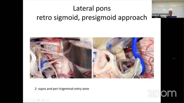 Surgery for Brainstem Glioma in children смотреть онлайн