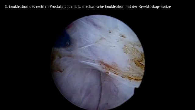 Die Thulium-Laser-Enukleation der Prostata (ThuLEP) смотреть онлайн