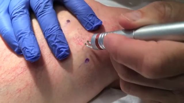 Combination Therapy for Complicated Reticular Spider Complex Using Dornier 940 Laser & Sclerotherap смотреть онлайн