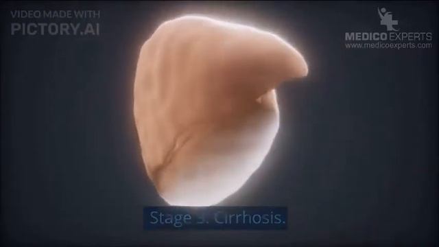 5 Stages of Liver Cirrhosis - Don't Let Liver Cirrhosis Take Control смотреть онлайн