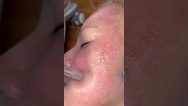 Micro-Needling with ZO firming serum. смотреть онлайн
