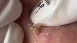 Выдавливание чёрных точек