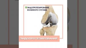Эндопротезирование коленного сустава