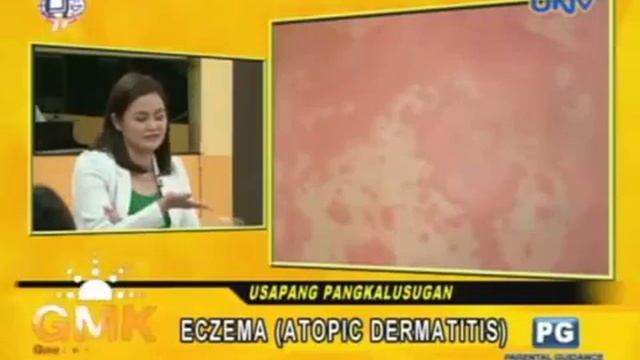 Dr. Kaycee Reyes on Good Morning Kuya Eczema (Atopic Dermatitis) смотреть онлайн