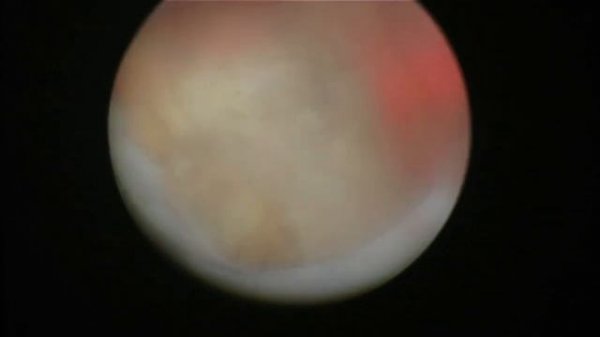 TUR prostate/ ТУР простаты. Case/Случай #30.