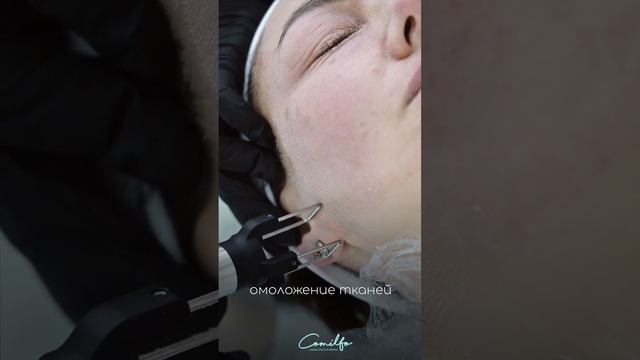 Лазерное омоложение в клинике Comilfo смотреть онлайн