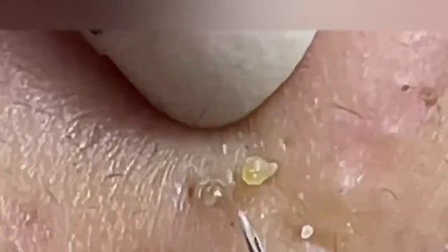 10 Shocking Blackhead Removals смотреть онлайн