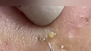 10 Shocking Blackhead Removals