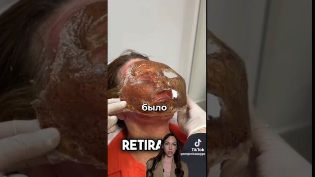 Феноловый пилинг , омоложение без хирургии #обучениекосметологов #красота #губымосква