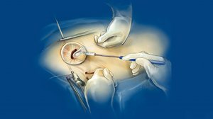 Миниинвазивная пластика митрального клапана