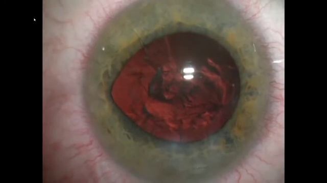 Факоэмульсификация катаракты