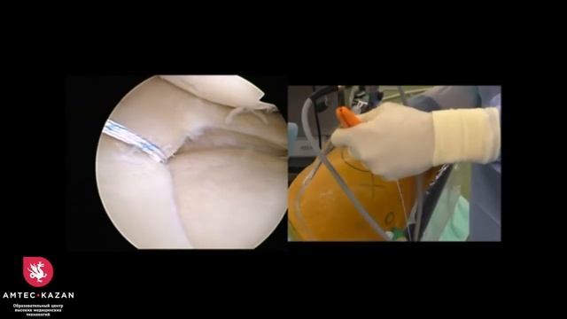 Повреждение мениска: Операция Банкарта