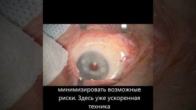 Укол в глаз #shorts Https://t.me/newera_community #education #facts #медицина #cataract