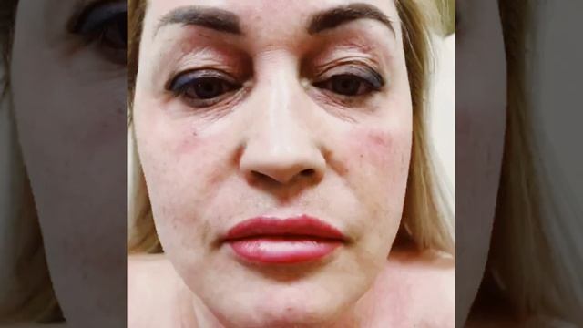 Реабилитация после.....