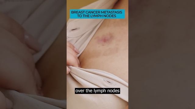 Spotting Symptoms of Breast Cancer Metastasis to Lymph Nodes 🎗️🔍#Cancer #Metastasis #cancerawarenes смотреть онлайн