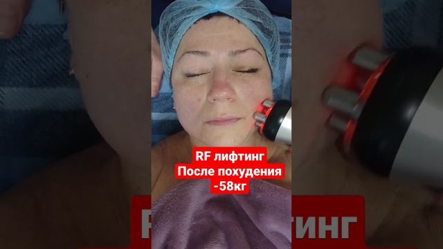 #shorts ПОДТЯЖКА ЛИЦА ПОСЛЕ ПОХУДЕНИЯ НА 58КГ смотреть онлайн
