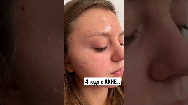 Моя история борьбы с АКНЕ🥹#акне #прыщиналице #воспаление #лицоуход #макияж смотреть онлайн