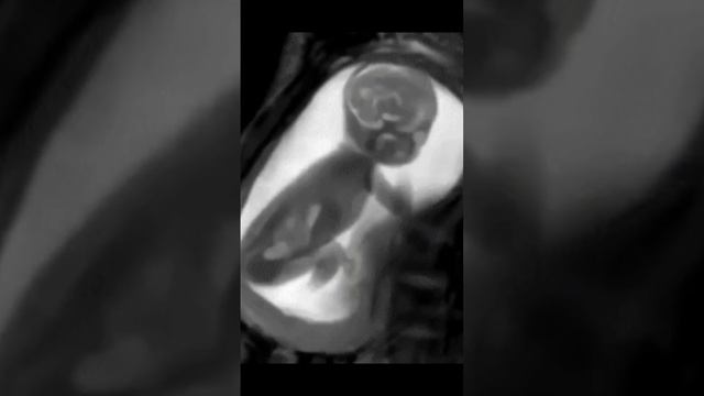 38 week fetus movement in ultrasound #shortsyoutube смотреть онлайн
