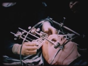 ТРЕПАНАЦИЯ. Криохирургия при операциях на головном мозге (СССР, 1970-е годы)