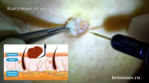 Удаление "родинки"