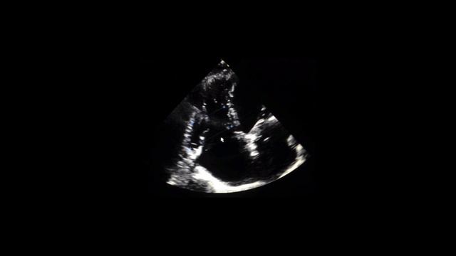 Grading mitral stenosis смотреть онлайн