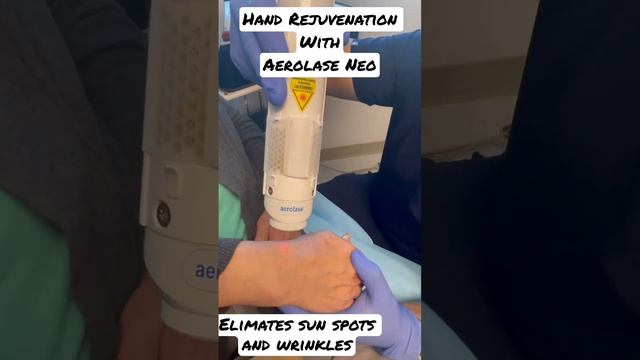 Hand Rejuvenation with the Aerolase Neo. Eliminate age spots, wrinkles and more with Dr. Milanes,MD смотреть онлайн