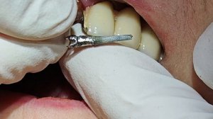 Секрет извлечения штифтовых культевых вкладок