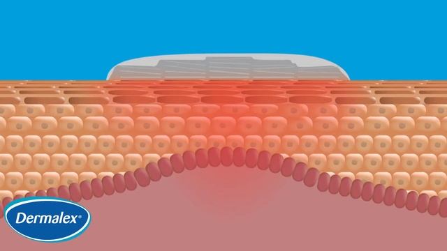 Dermalex Psoriasis RU смотреть онлайн