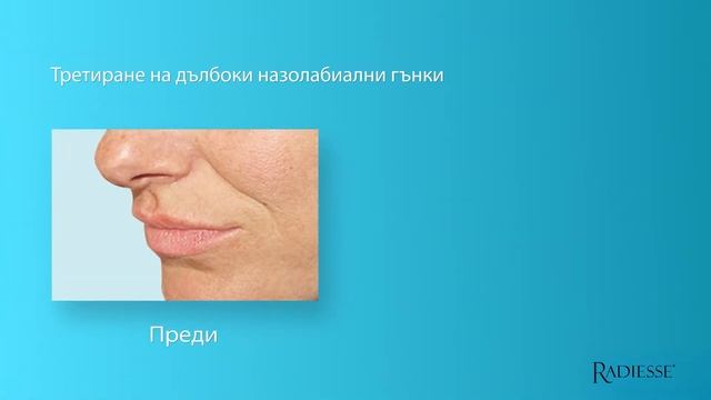 Дермалните филъри Radiesse смотреть онлайн