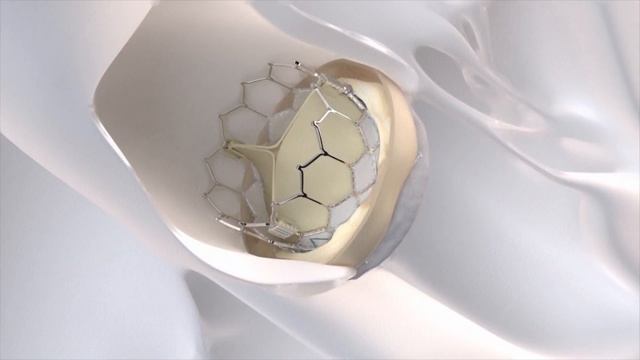Transcatheter Aortic Valve Replacement (TAVR) for Aortic Stenosis смотреть онлайн
