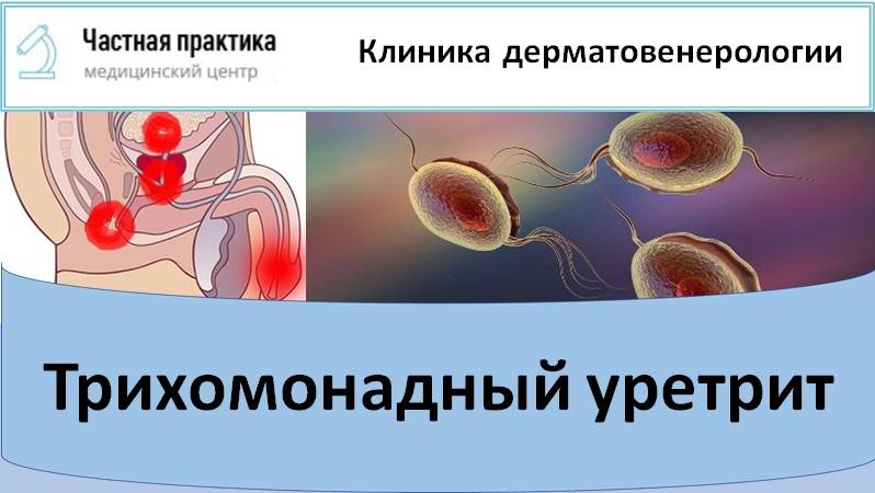 Трихомонадный уретрит смотреть онлайн