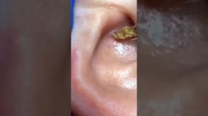 Monster Blackhead In Ear #01